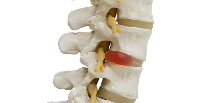 Herinated disc relief from chiropractic in Roseville