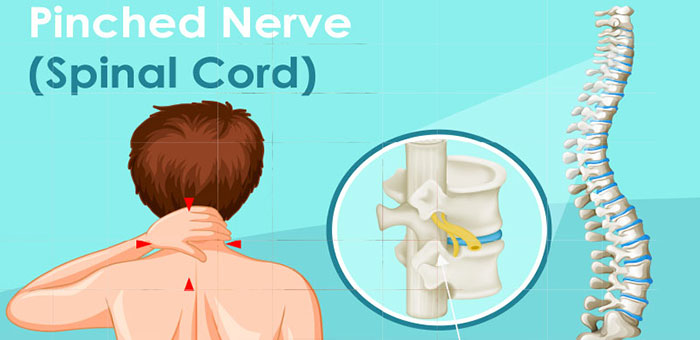 Chiropractic for pinched nerve pain relief in Roseville