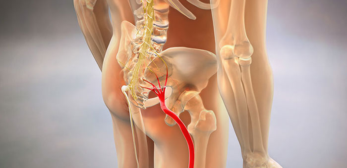 Sciatica relief in Roseville