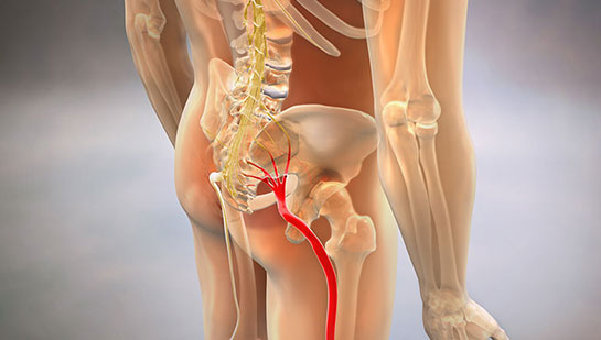 Sciatica relief in Roseville