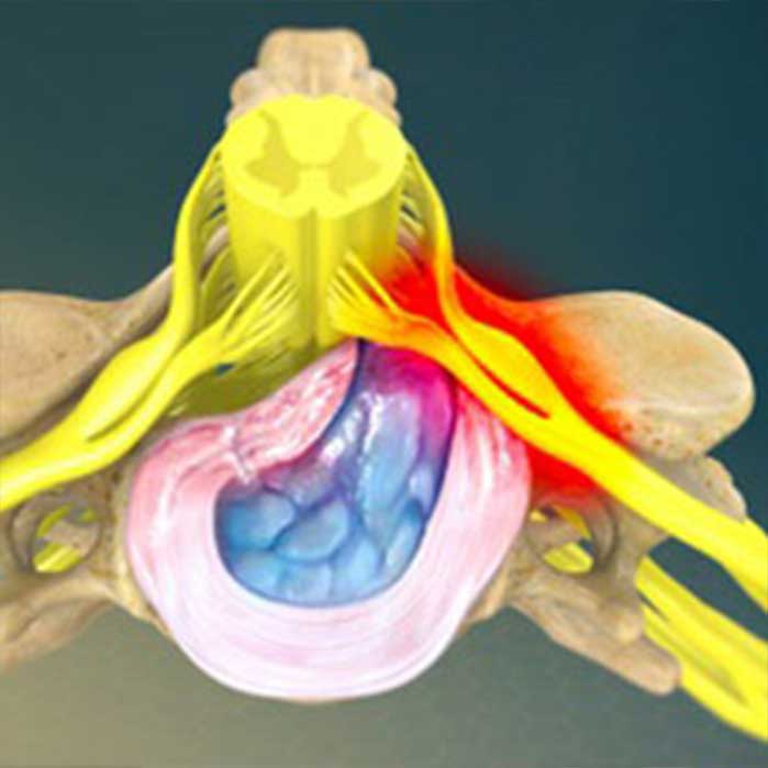 Chiropractic for herniated disc in Roseville