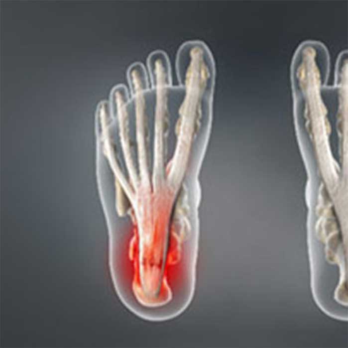 Chiropractic for plantar fasciitis in Roseville