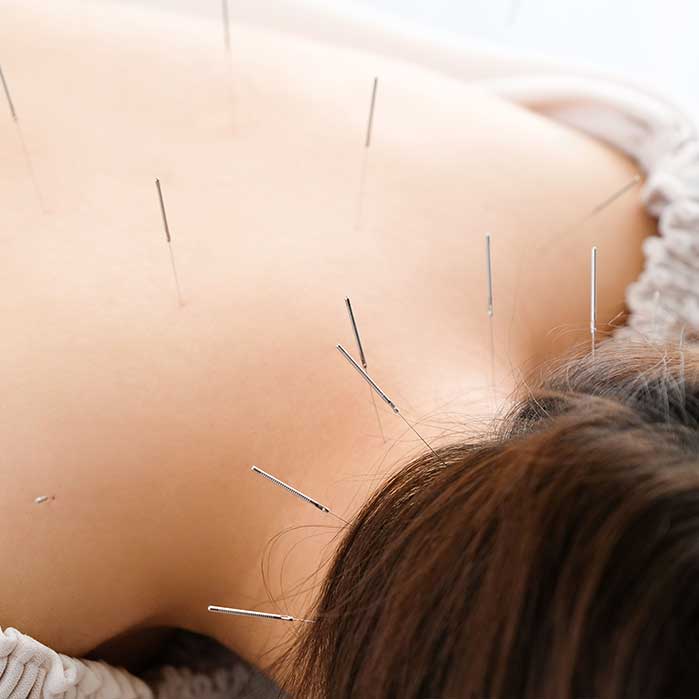 Acupuncture in Roseville